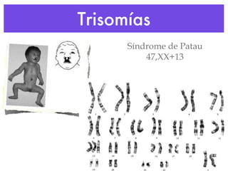 Trisomías Síndrome de Patau 47,XX+13 