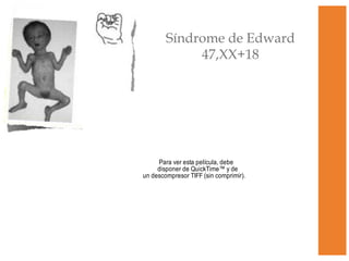 Síndrome de Edward 47,XX+18 