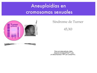 Aneuploidías en  cromosomas sexuales Síndrome de Turner 45,X0 