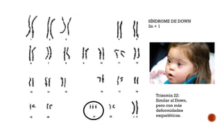 SÍNDROME DE DOWN
2n + 1
Trisomía 22:
Similar al Down,
pero con más
deformidades
esqueléticas.
 