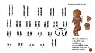 Síndrome de Edwards
Deformaciones del
oído, defectos
cardiacos,
espasticidad, otras
lesiones; muerte a la
edad de un año.
 
