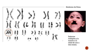 Síndrome de Patau
Defectos
múltiples y la
muerte a la
edad de uno a
tres meses.
 