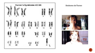 Síndrome de Turner
 