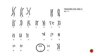 TRISOMÍA DEL PAR 21
2n + 1
 