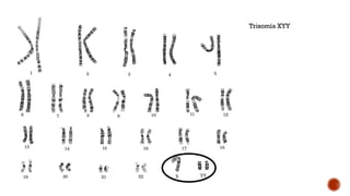 Trisomía XYY
 