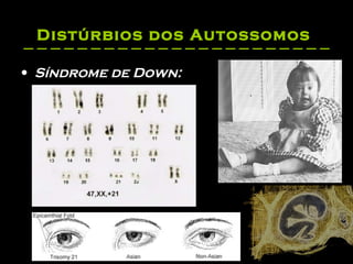 Distúrbios dos Autossomos   Síndrome de Down:   