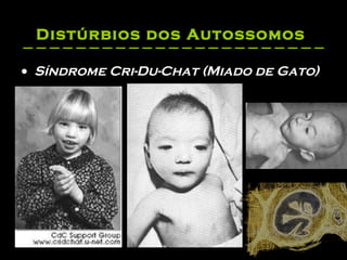 Distúrbios dos Autossomos   Síndrome Cri-Du-Chat (Miado de Gato) 