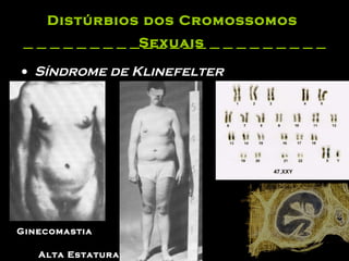 Distúrbios dos Cromossomos  Sexuais   Síndrome de Klinefelter  Ginecomastia   Alta Estatura   