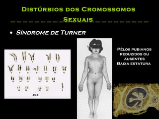 Distúrbios dos Cromossomos  Sexuais   Síndrome de Turner Pêlos pubianos reduzidos ou ausentes Baixa estatura   