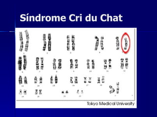 Síndrome Cri du Chat 