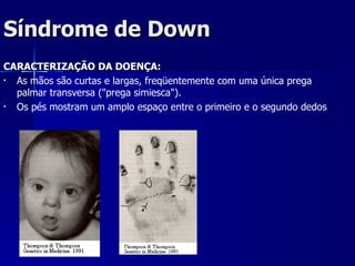 Síndrome de Down CARACTERIZAÇÃO DA DOENÇA: As mãos são curtas e largas, freqüentemente com uma única prega palmar transversa ("prega simiesca").  Os pés mostram um amplo espaço entre o primeiro e o segundo dedos 