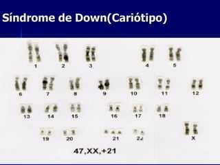 Síndrome de Down(Cariótipo) 
