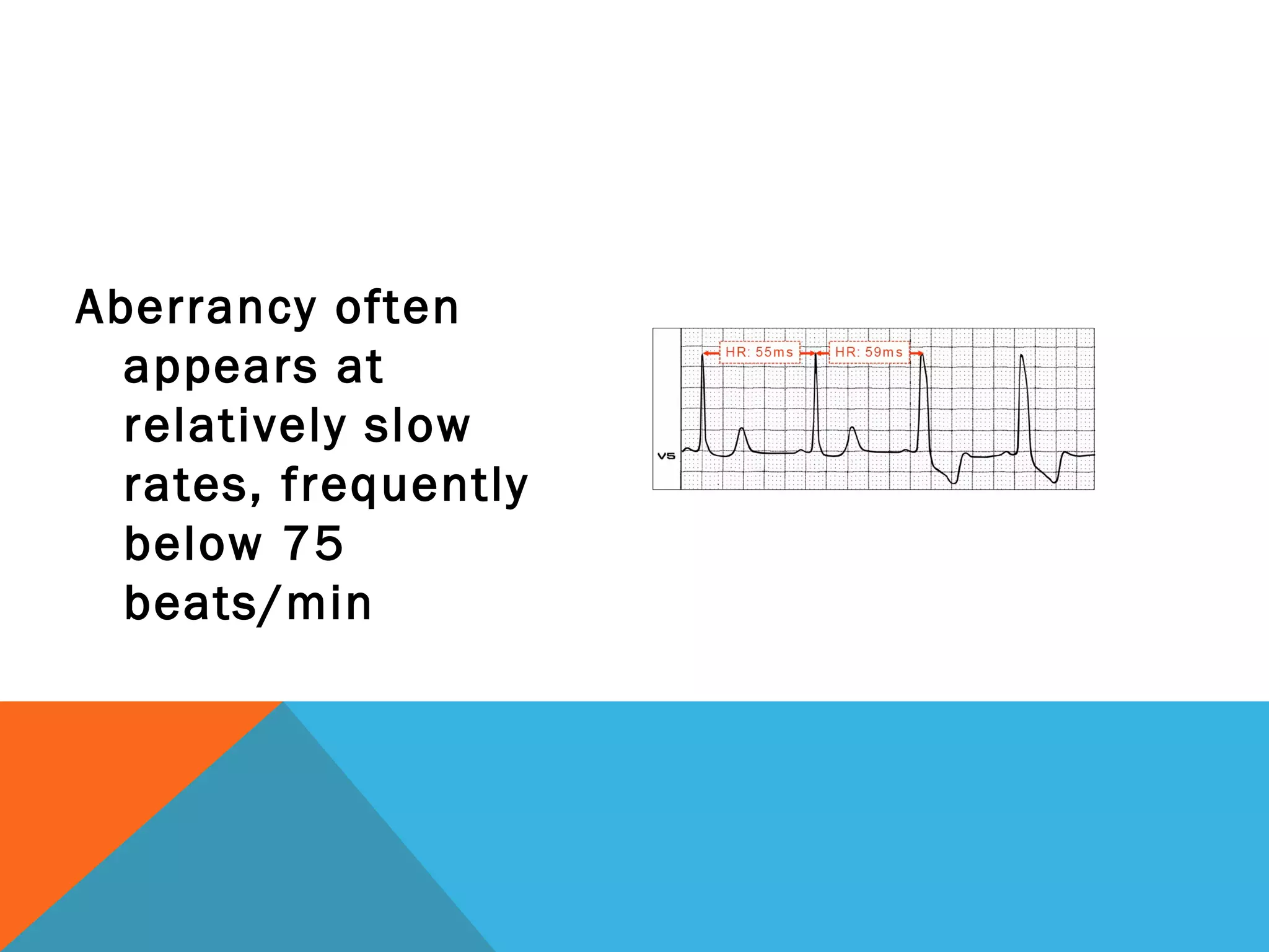 Aberrancy often
  appears at
  relatively slow
  rates, frequently
  below 75
  beats/min
 
