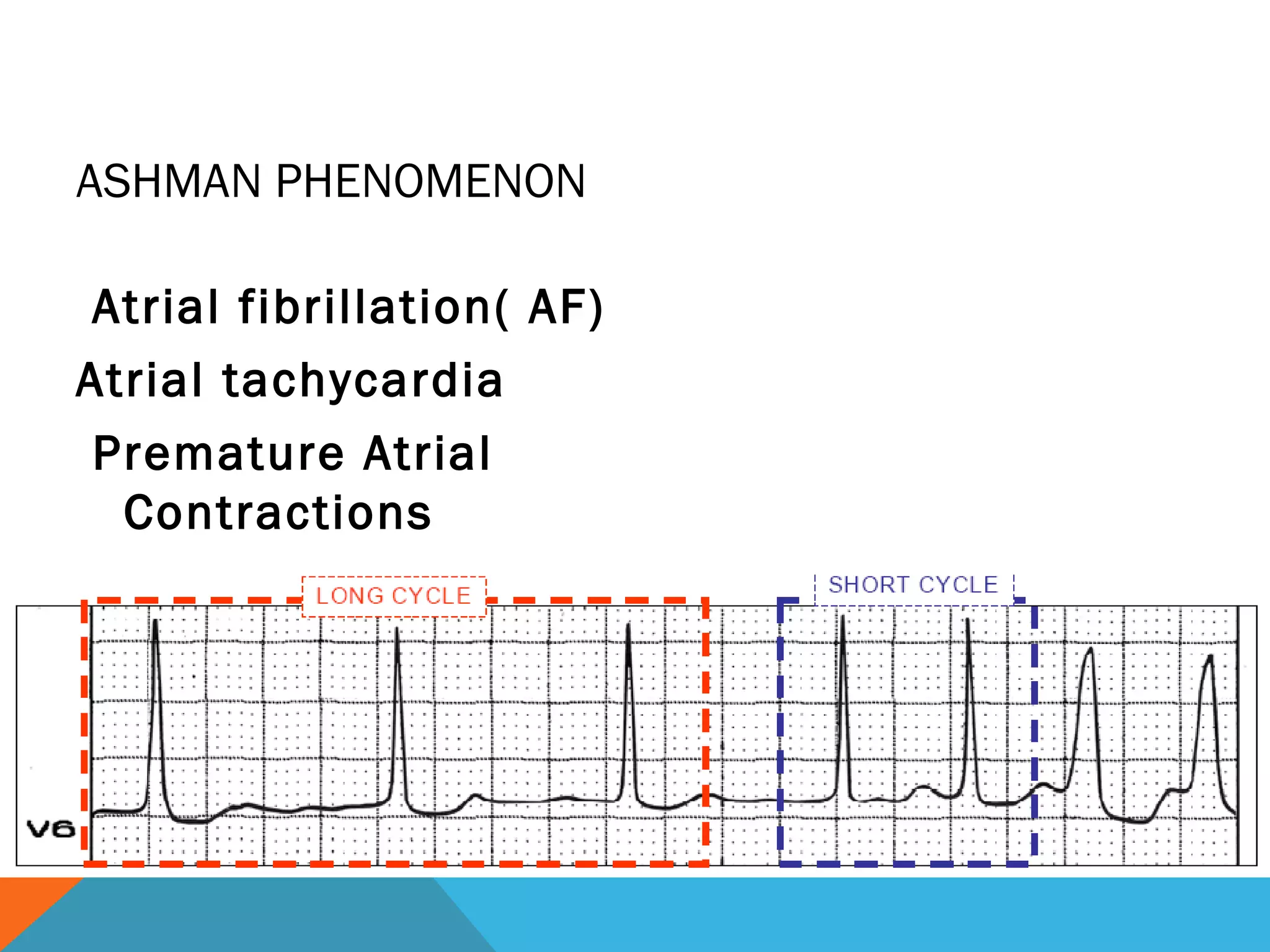 ASHMAN PHENOMENON

 Atrial fibrillation( AF)
Atrial tachycardia
 Premature Atrial
  Contractions
 