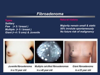 Fibroadenoma
Types                                Natural history
Solitary
Few (< 5 / breast )                  Majority remain small & static
Multiple (> 5 / breast )             50% involute spontaneously
Giant (> 4 / 5 cms) & Juvenile       No future risk of malignancy
 