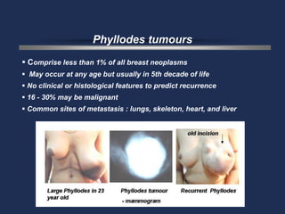 Phyllodes tumours
 Comprise less than 1% of all breast neoplasms
 May occur at any age but usually in 5th decade of life
 No clinical or histological features to predict recurrence
 16 - 30% may be malignant
 Common sites of metastasis : lungs, skeleton, heart, and liver
 
