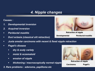 4. Nipple changes

Causes :
1.   Developmental inversion
2.   Acquired inversion
    Periductal mastitis
    Duct ectasia (classical slit retraction)
    Juxta areolar carcinoma with recent & fixed nipple retraction
    Paget’s disease
        dry & scaly variety
        moist & eczematoid
        erosion of nipple
        thickening / macroscopically normal nipple
3. Rare problems : adenoma, papilloma etc
 