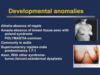 Developmental anomalies

Athelia-absence of nipple
Amazia-absence of breast tissue.asso with
  poland syndrome
  POLYMASTIA-common
Commonly in axilla
Supernumerary nipples-male
  predominance 1.7:1
Assn. With other syndrome-
  turner,fanconi,ectodermal dysplasia
 