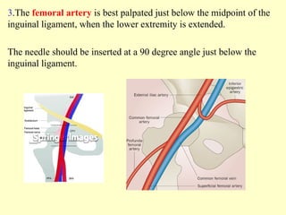 3.The femoral artery is best palpated just below the midpoint of the
inguinal ligament, when the lower extremity is extended.
The needle should be inserted at a 90 degree angle just below the
inguinal ligament.
 