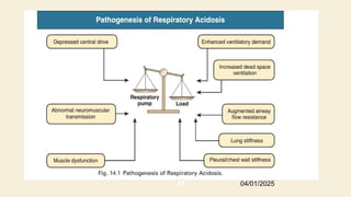 Respiratory acidosis
04/01/2025
69
 