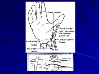 Getting an arterial blood gas sample