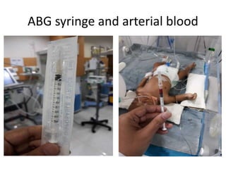 ABG syringe and arterial blood
 