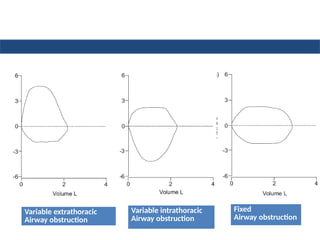 Fixed
Airway obstruction
Variable extrathoracic
Airway obstruction
Variable intrathoracic
Airway obstruction
 