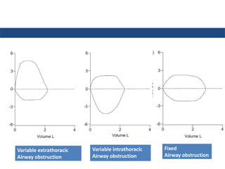 Fixed
Airway obstruction
Variable extrathoracic
Airway obstruction
Variable intrathoracic
Airway obstruction
 