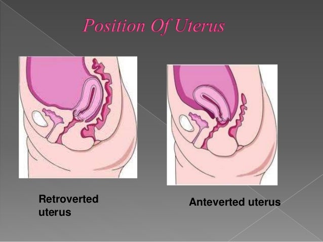 Anteverted Uterus