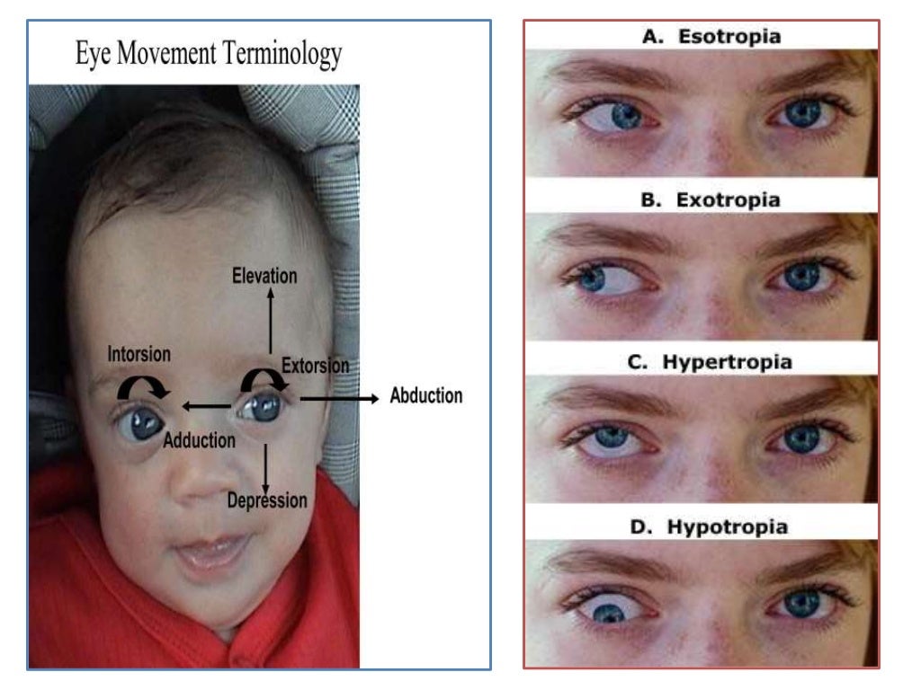 Oculomotor palsy