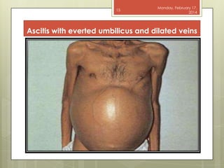 15

Monday, February 17,
2014

Ascitis with everted umbilicus and dilated veins

 