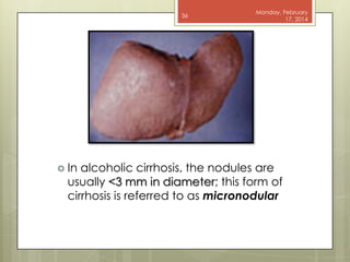 36

 In

Monday, February
17, 2014

alcoholic cirrhosis, the nodules are
usually <3 mm in diameter; this form of
cirrhosis is referred to as micronodular

 