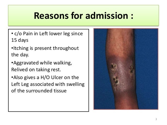 Venous Ulcer venous-ulcer