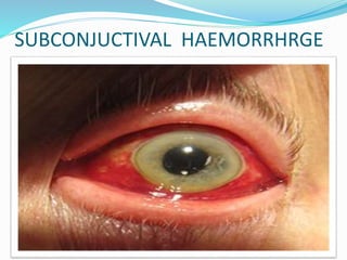 SUBCONJUCTIVAL HAEMORRHRGE
 