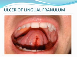 ULCER OF LINGUAL FRANULUM
 