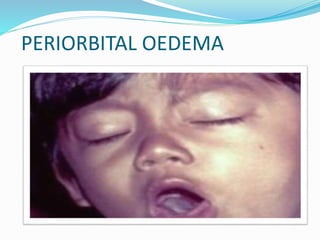 PERIORBITAL OEDEMA
 