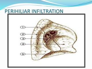 PERIHILIAR INFILTRATION
 