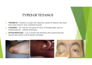Tetanus Injuries TETANUS Department of Physiotherapy, SHUATS, Prayagraj | PPTX
