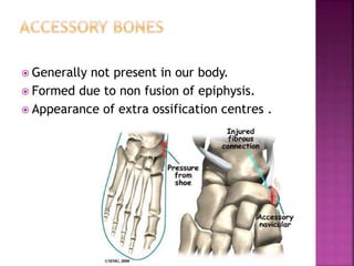  Generally not present in our body.
 Formed due to non fusion of epiphysis.
 Appearance of extra ossification centres .
 