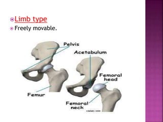 Limb type
 Freely movable.
 