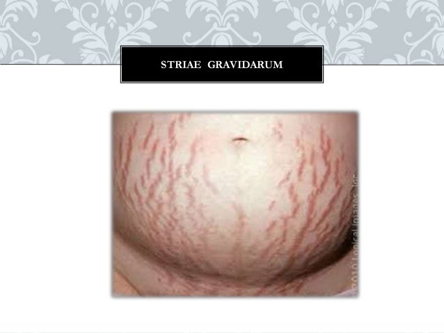 Sign and symptoms of pregnancy & Minor Ailments during pregnancy