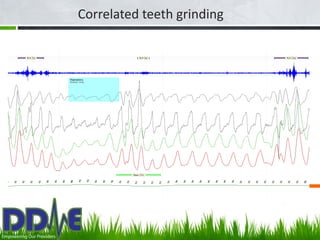 Correlated teeth grinding




     Bruxism associated with
     OSA
 