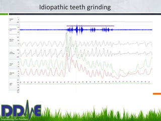 Idiopathic teeth grinding




     Idiopathic Bruxism - TMD
 