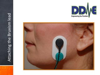 Attaching the Bruxism lead
 