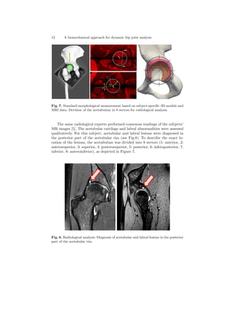 12 A biomechanical approach for dynamic hip joint analysis
Fig. 7. Standard morphological measurement based on subject-speciﬁc 3D models and
MRI data. Devision of the acetabulum in 8 sectors for radiological analysis.
The same radiological experts performed consensus readings of the subjects’
MR images [5]. The acetabular cartilage and labral abnormalities were assessed
qualitatively. For this subject, acetabular and labral lesions were diagnosed in
the posterior part of the acetabular rim (see Fig.8). To describe the exact lo-
cation of the lesions, the acetabulum was divided into 8 sectors (1: anterior, 2:
anterosuperior, 3: superior, 4: posterosuperior, 5: posterior, 6: inferoposterior, 7:
inferior, 8: anteroinferior), as depicted in Figure 7.
Fig. 8. Radiological analysis: Diagnosis of acetabular and labral lesions in the posterior
part of the acetabular rim.
 