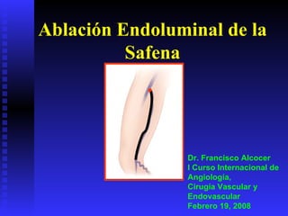 Ablación Endoluminal de la Safena Dr. Francisco Alcocer I Curso Internacional de Angiología,  Cirugía Vascular y Endovascular Febrero 19, 2008 . 