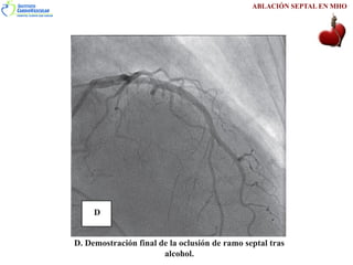 Ablación Septal en la Miocardiopatía Hipertrófica | PDF