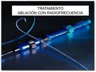 TRATAMIENTO
ABLACIÓN CON RADIOFRECUENCIA
 