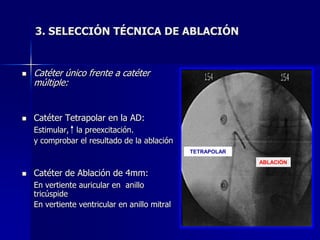 3. SELECCIÓN TÉCNICA DE ABLACIÓN


   Catéter único frente a catéter
    múltiple:


   Catéter Tetrapolar en la AD:
    Estimular, la preexcitación.
    y comprobar el resultado de la ablación
                                                TETRAPOLAR

                                                             ABLACIÓN

   Catéter de Ablación de 4mm:
    En vertiente auricular en anillo
    tricúspide
    En vertiente ventricular en anillo mitral
 