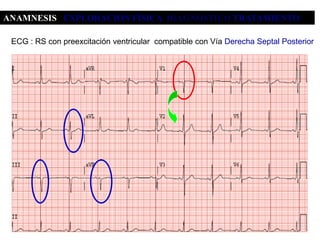 ANAMNESIS EXPLORACIÓN FÍSICA DIAGNÓSTICO TRATAMIENTO

 ECG : RS con preexcitación ventricular compatible con Vía Derecha Septal Posterior
 